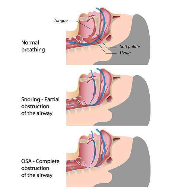 Sleep Apnea Treatment in Atlanta, GA